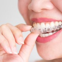 invisalign